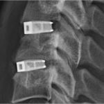 3d Drucker G Code Vorlagen Erstaunlich Fda Erteilt Zulassung Für Titan Wirbelsäulenimplantate Aus