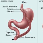 Fastentagebuch Vorlage Best Of Akupunktur Abnehmen Fenbach Post