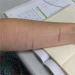 Kleid Nach Vorlage Schneidern Lassen Großartig Tattoos über Narben ist Es Möglich Was Muss Ich Beachten