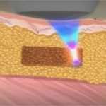 Non Dual Use Erklärung Vorlage Erstaunlich solta Medical Produkte Medicopro thermage Fraxel